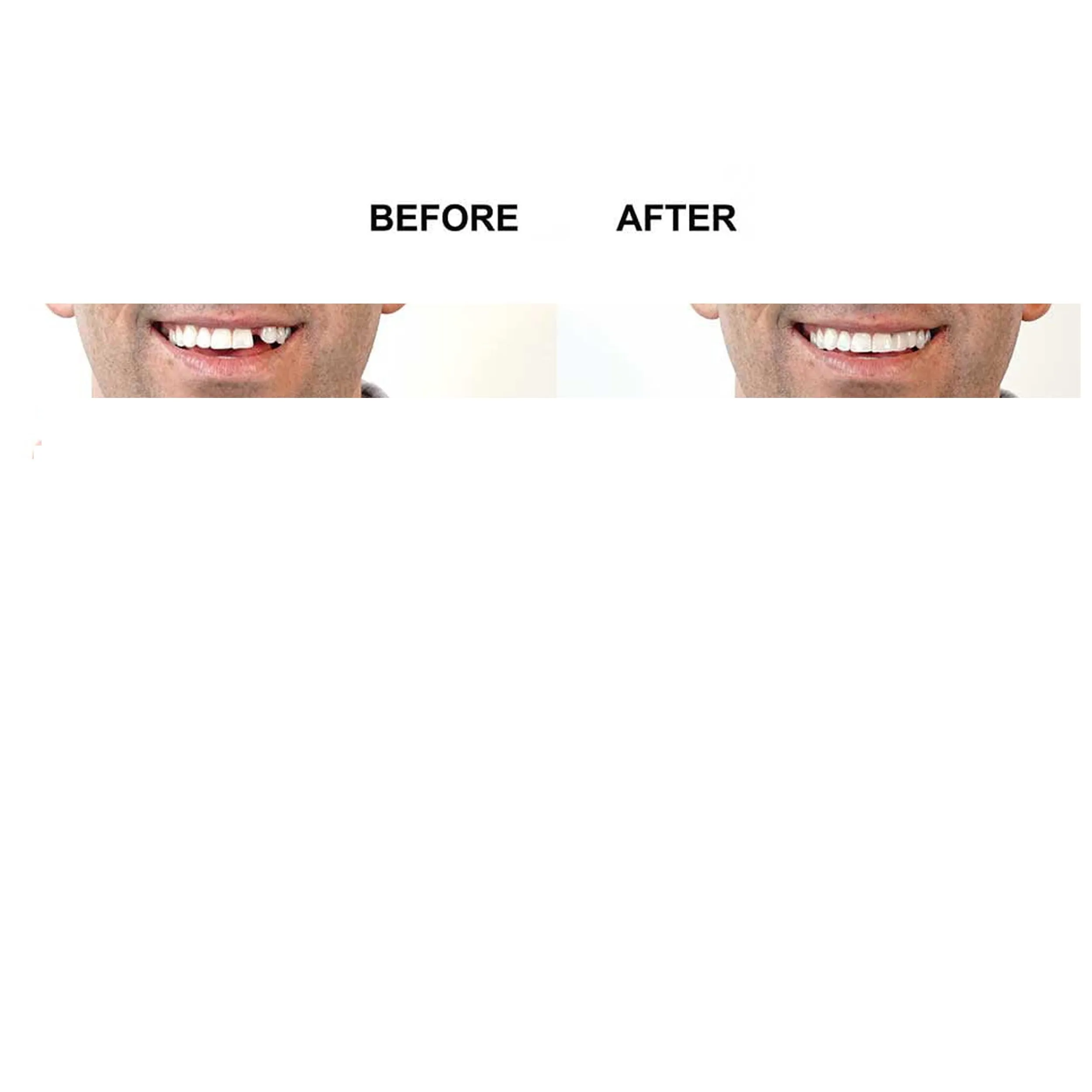 Complete Denture Repair & Reline Teeth Kit